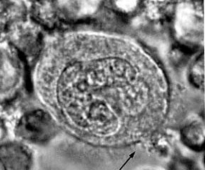 Una foto eccezionale scattata a microscopio elettronico: un Megacariocita, in soluzione di Melatonina e Adp (melatonina “coniugata”). La freccia evidenzia il getto di piastrine - indotto dalla Mlt - che esce dalla membrana del megacariocita, incontrovertibile dimostrazione dell’influenza della Mlt nella piastrinogenesi.